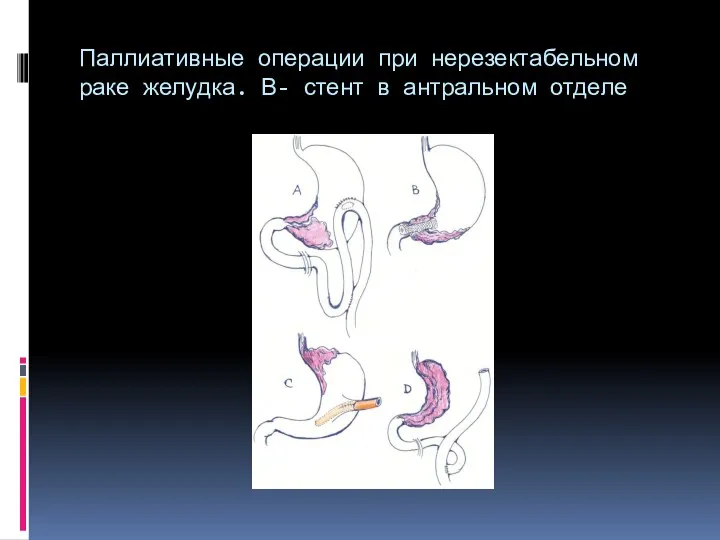 Паллиативные операции при нерезектабельном раке желудка. В- стент в антральном отделе