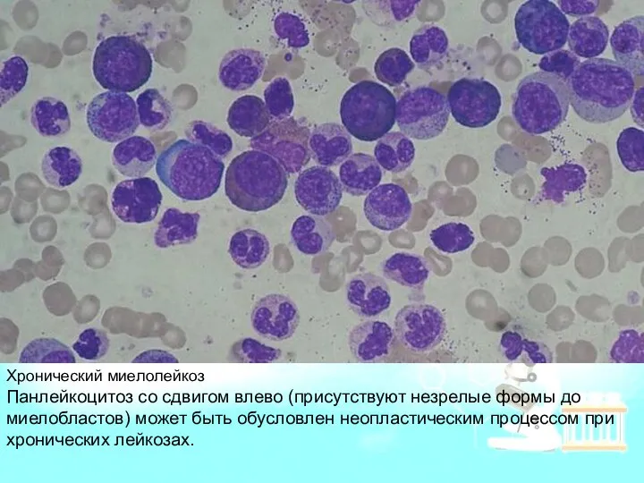 Хронический миелолейкоз Панлейкоцитоз со сдвигом влево (присутствуют незрелые формы до миелобластов)