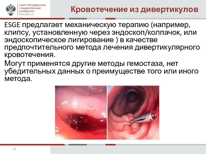 Кровотечение из дивертикулов ESGE предлагает механическую терапию (например, клипсу, установленную через