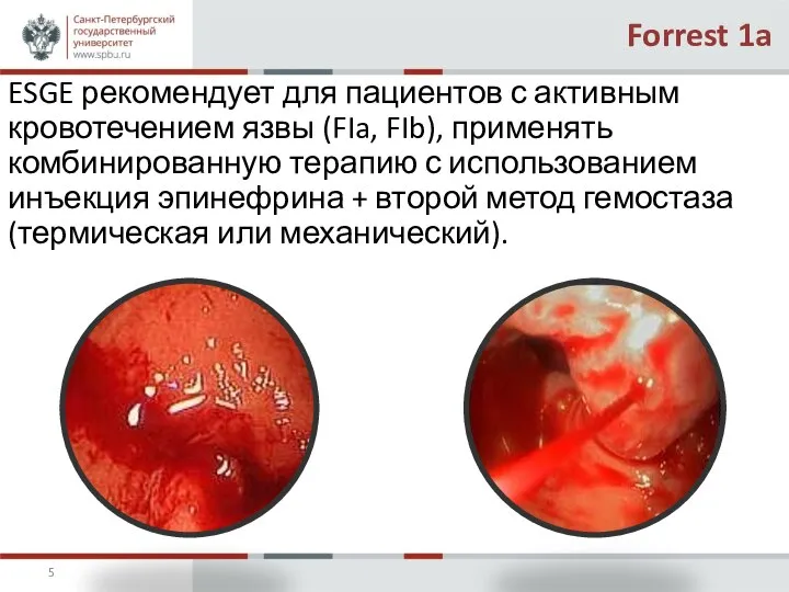 Forrest 1a ESGE рекомендует для пациентов с активным кровотечением язвы (FIa,