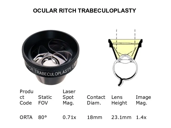 OCULAR RITCH TRABECULOPLASTY