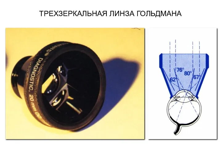 ТРЕХЗЕРКАЛЬНАЯ ЛИНЗА ГОЛЬДМАНА