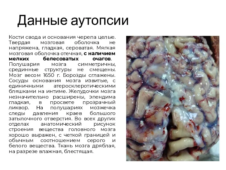 Данные аутопсии Кости свода и основания черепа целые. Твердая мозговая оболочка