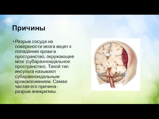 Причины Разрыв сосуда на поверхности мозга ведет к попаданию крови в