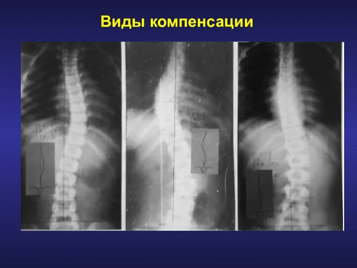 Виды компенсации