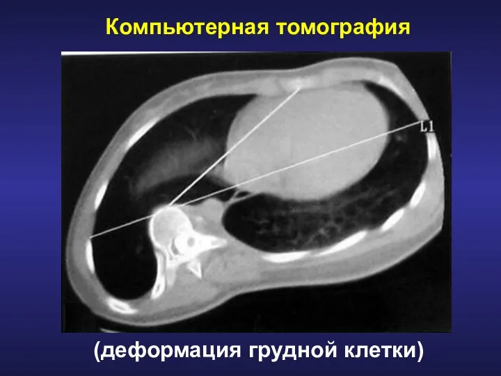 Компьютерная томография (деформация грудной клетки)