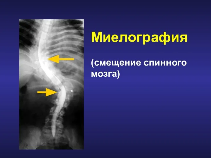 Миелография (смещение спинного мозга)