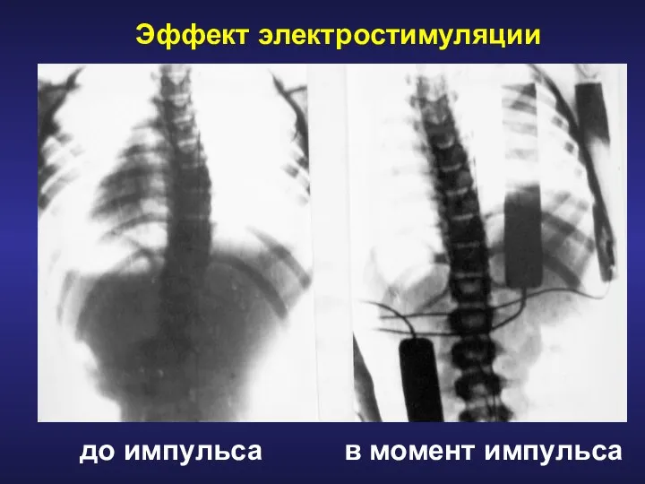 Эффект электростимуляции до импульса в момент импульса