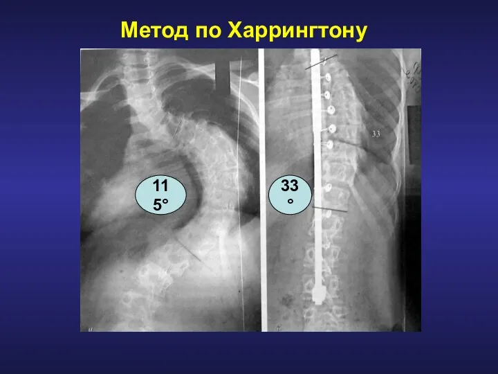 Метод по Харрингтону 115° 33°