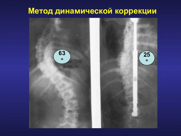 Метод динамической коррекции 63° 25°