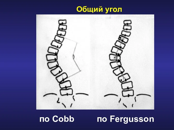 по Cobb по Fergusson Общий угол