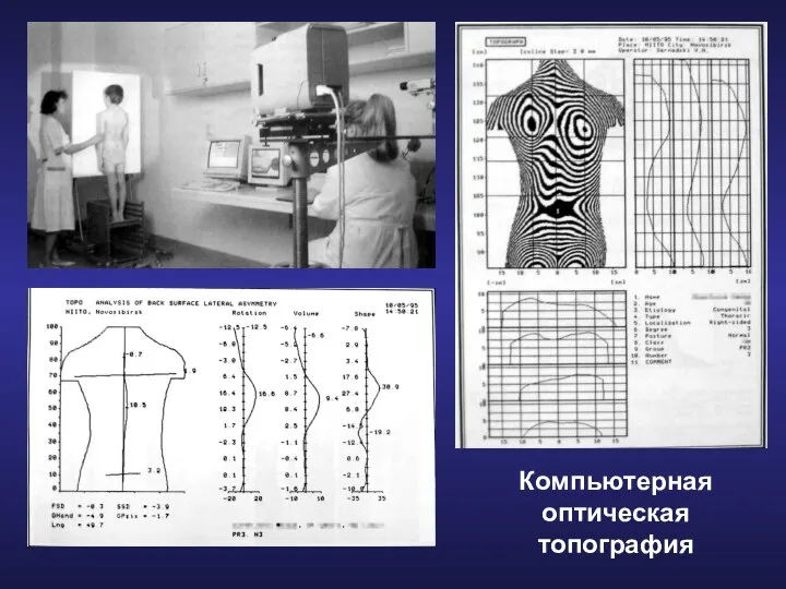 Компьютерная оптическая топография