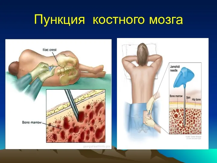 Пункция костного мозга