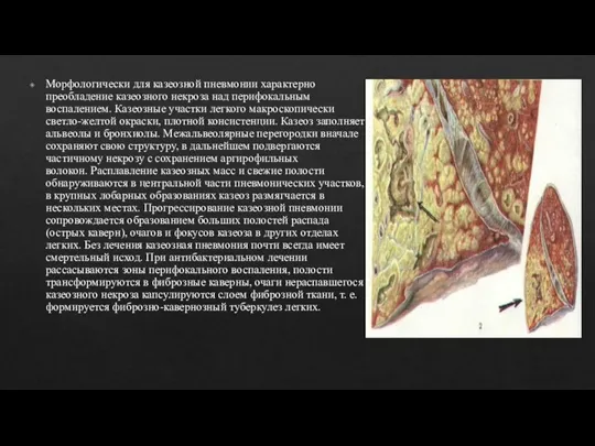 Морфологически для казеозной пневмонии характерно преобладение казеозного некроза над перифокальным воспалением.