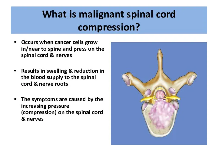 What is malignant spinal cord compression? Occurs when cancer cells grow