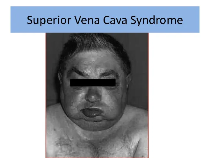 Superior Vena Cava Syndrome