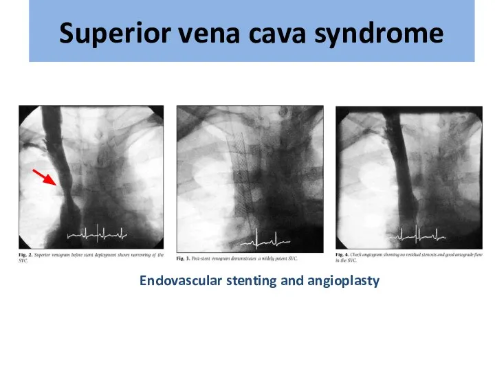 Endovascular stenting and angioplasty Superior vena cava syndrome