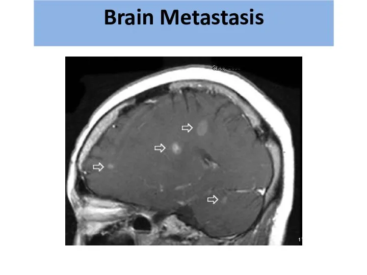 גרורות מוחיות Brain Metastasis