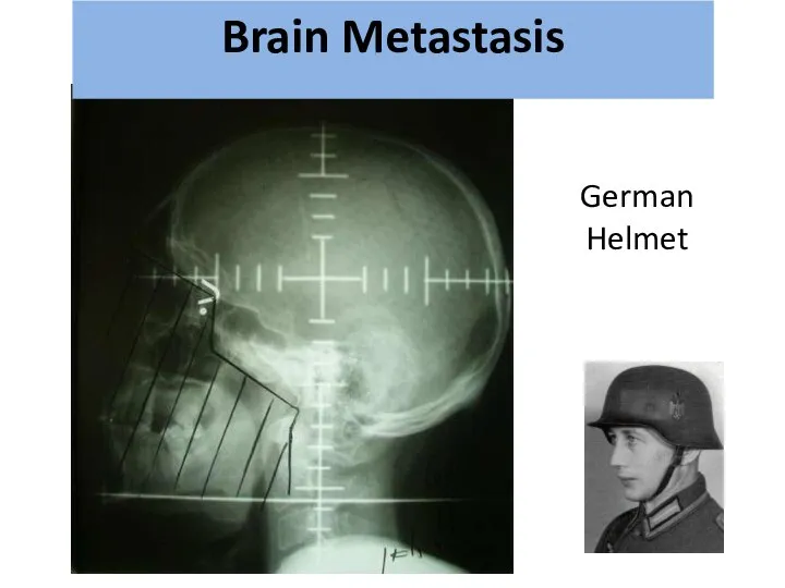 גרורות מוחיות German Helmet Brain Metastasis