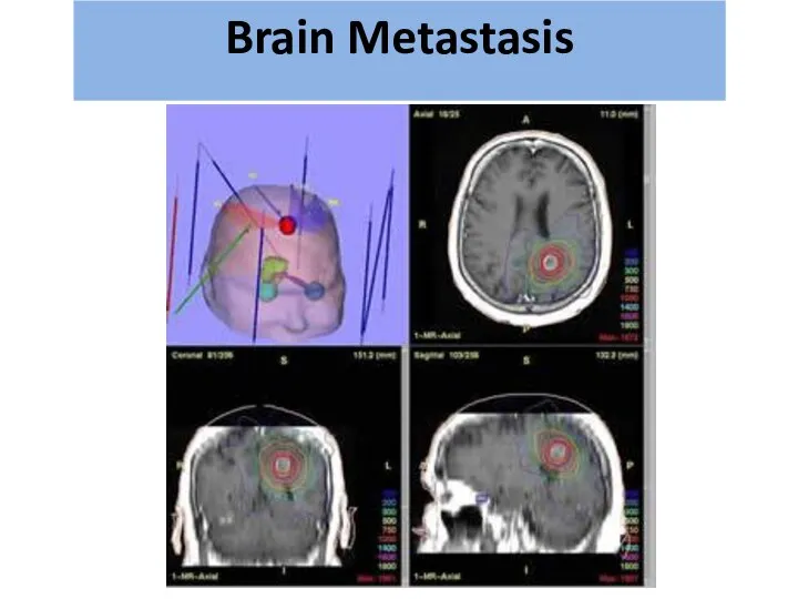 גרורות מוחיות Brain Metastasis