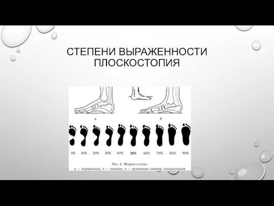 СТЕПЕНИ ВЫРАЖЕННОСТИ ПЛОСКОСТОПИЯ