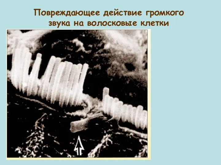Повреждающее действие громкого звука на волосковые клетки