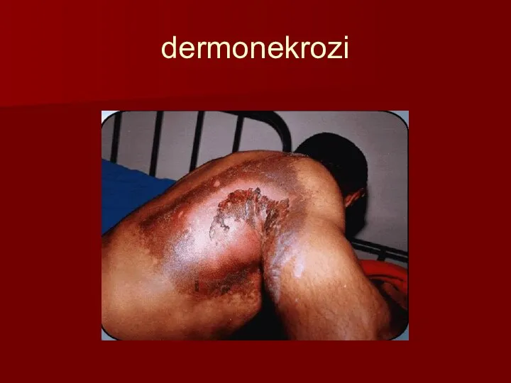 dermonekrozi