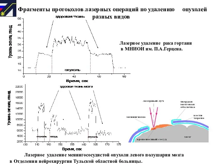 Фрагменты протоколов лазерных операций по удалению опухолей разных видов Лазерное удаление