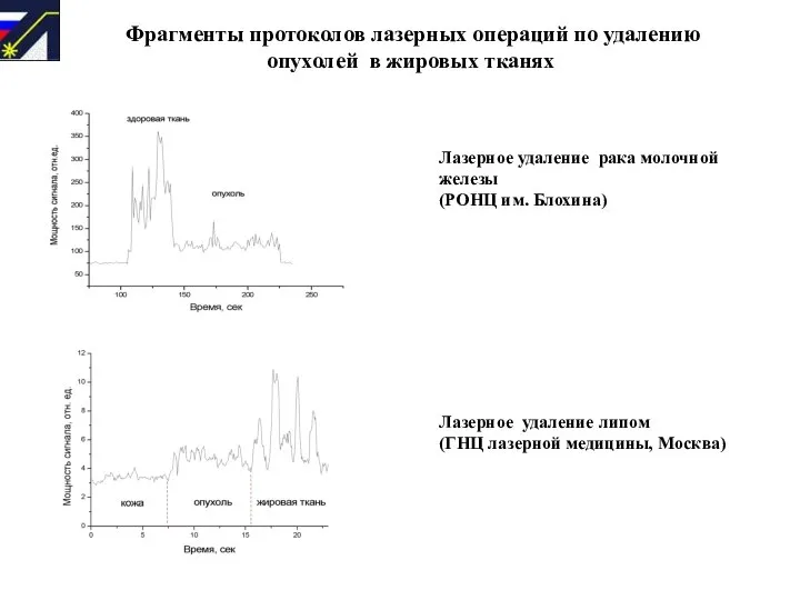 Фрагменты протоколов лазерных операций по удалению опухолей в жировых тканях Лазерное