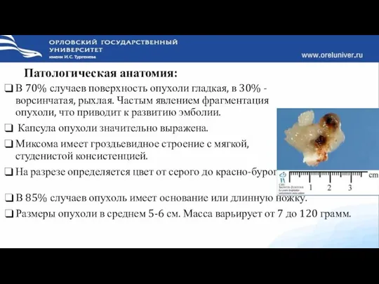 Патологическая анатомия: В 70% случаев поверхность опухоли гладкая, в 30% -