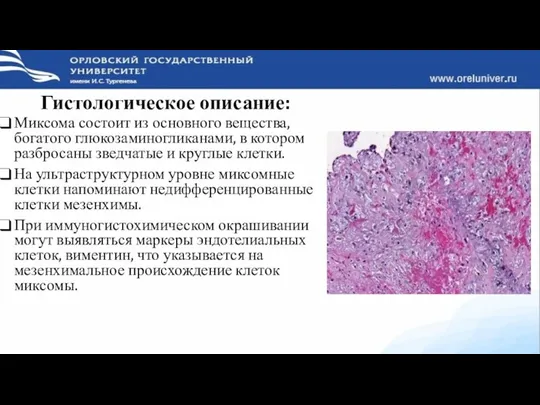 Гистологическое описание: Миксома состоит из основного вещества, богатого глюкозаминогликанами, в котором