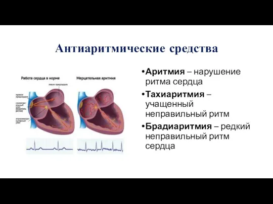 Антиаритмические средства Аритмия – нарушение ритма сердца Тахиаритмия – учащенный неправильный