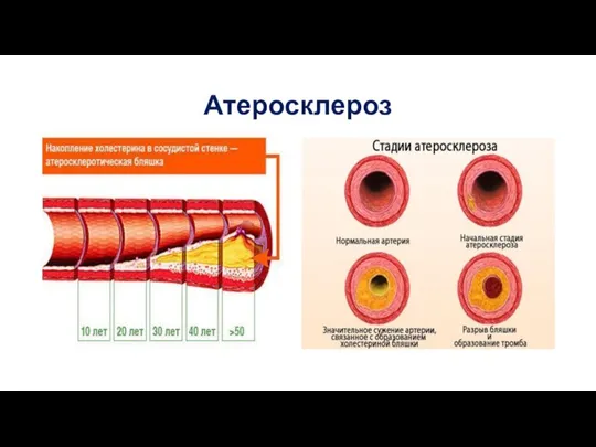 Атеросклероз