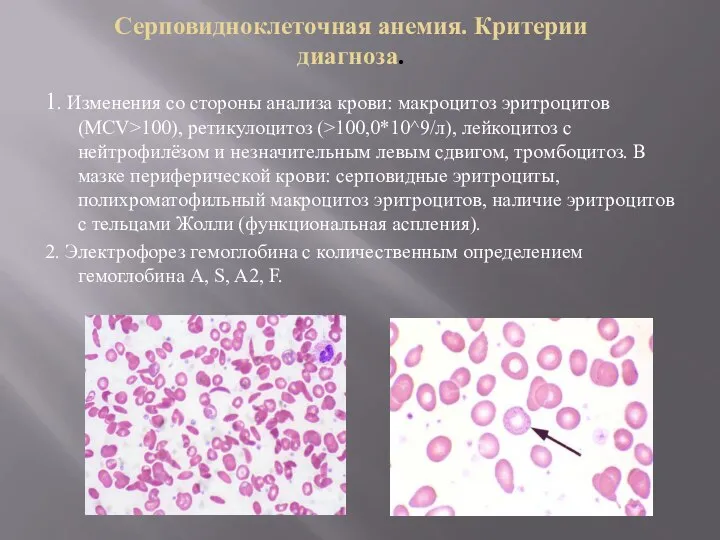 Серповидноклеточная анемия. Критерии диагноза. 1. Изменения со стороны анализа крови: макроцитоз