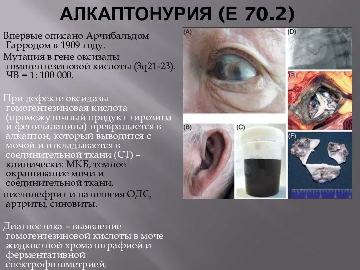 АЛКАПТОНУРИЯ (Е 70.2) Впервые описано Арчибальдом Гарродом в 1909 году. Мутация
