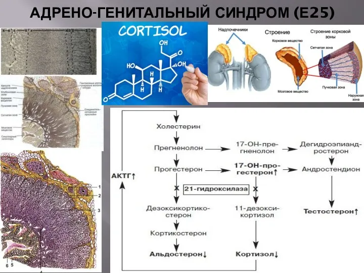 АДРЕНО-ГЕНИТАЛЬНЫЙ СИНДРОМ (Е25)