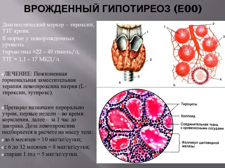 ВРОЖДЕННЫЙ ГИПОТИРЕОЗ (Е00) Диагностический меркер – тироксин, ТТГ крови. В норме