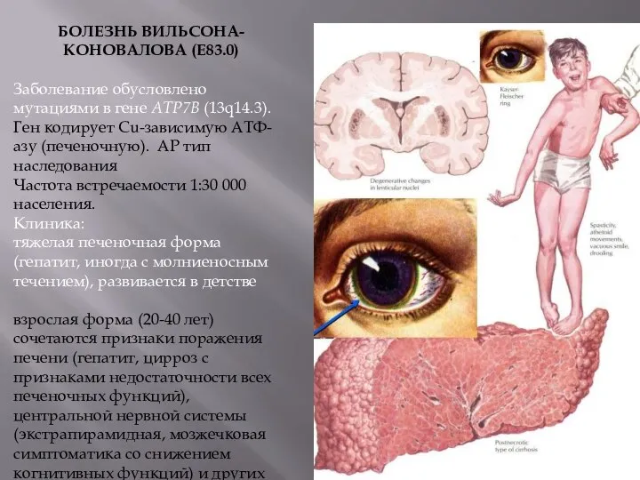 БОЛЕЗНЬ ВИЛЬСОНА-КОНОВАЛОВА (Е83.0) Заболевание обусловлено мутациями в гене АТР7В (13q14.3). Ген