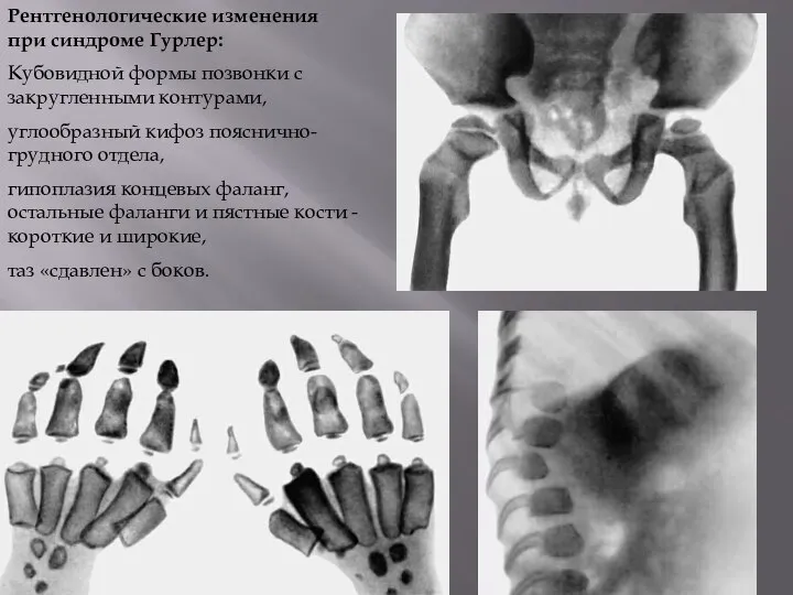 Рентгенологические изменения при синдроме Гурлер: Кубовидной формы позвонки с закругленными контурами,