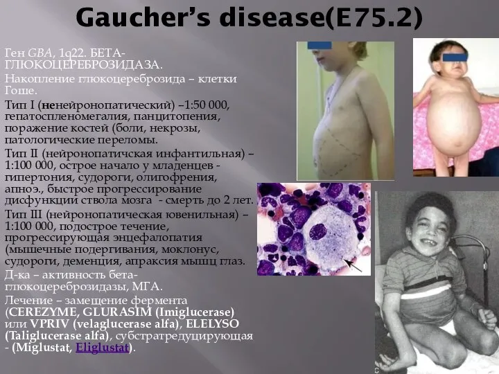 Gaucher’s disease(E75.2) Ген GBA, 1q22. БЕТА-ГЛЮКОЦЕРЕБРОЗИДАЗА. Накопление глюкоцереброзида – клетки Гоше.