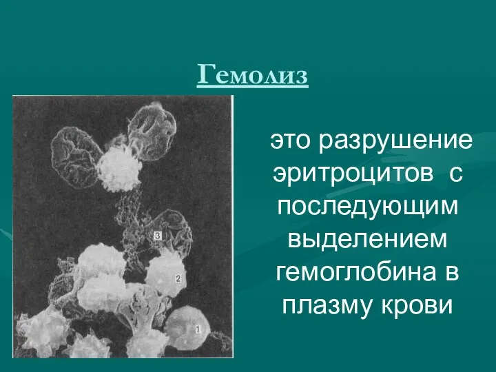 Гемолиз это разрушение эритроцитов с последующим выделением гемоглобина в плазму крови