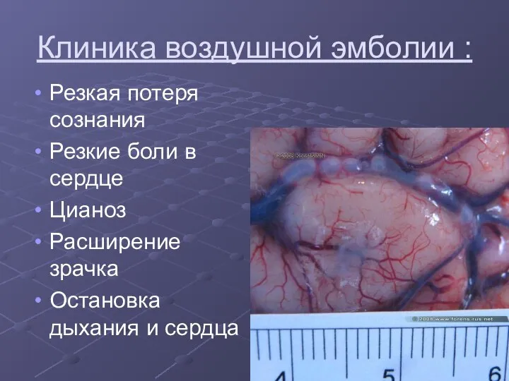 Клиника воздушной эмболии : Резкая потеря сознания Резкие боли в сердце