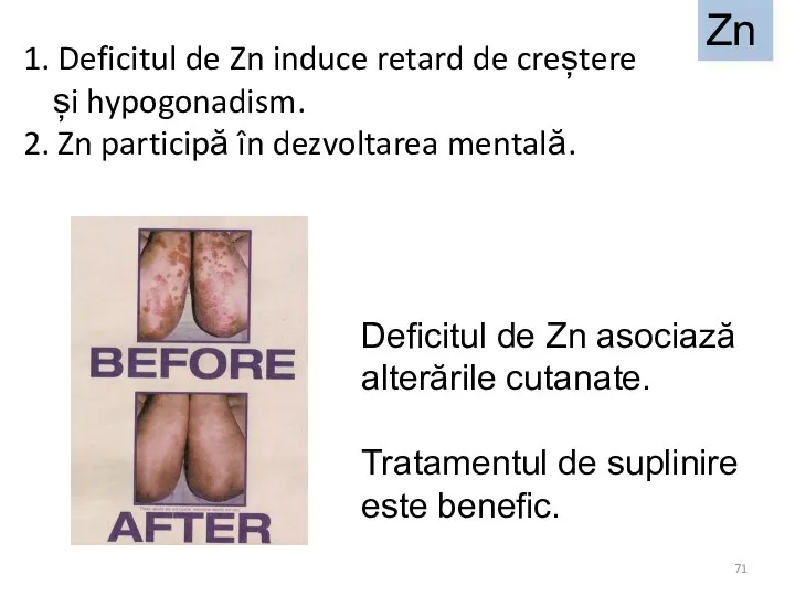 1. Deficitul de Zn induce retard de creștere și hypogonadism. 2.