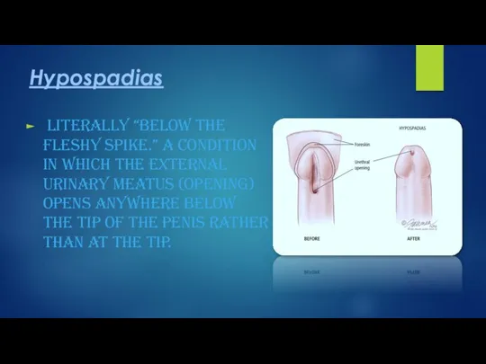 Hypospadias literally “below the fleshy spike.” A condition in which the