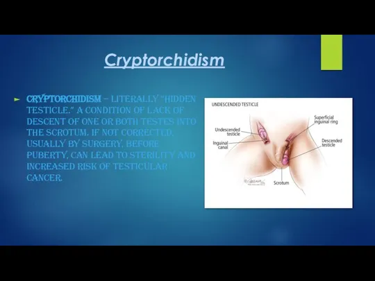 Cryptorchidism Cryptorchidism – literally “hidden testicle.” A condition of lack of