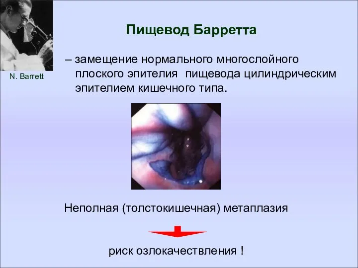 Пищевод Барретта N. Barrett – замещение нормального многослойного плоского эпителия пищевода