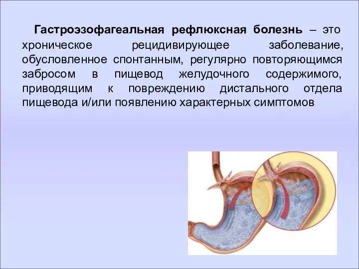 Гастроэзофагеальная рефлюксная болезнь – это хроническое рецидивирующее заболевание, обусловленное спонтанным, регулярно