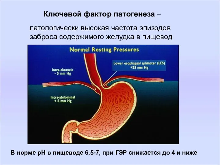 Ключевой фактор патогенеза – патологически высокая частота эпизодов заброса содержимого желудка