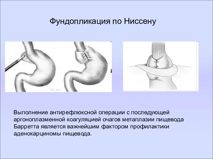 Фундопликация по Ниссену Выполнение антирефлюксной операции с последующей аргоноплазменной коагуляцией очагов