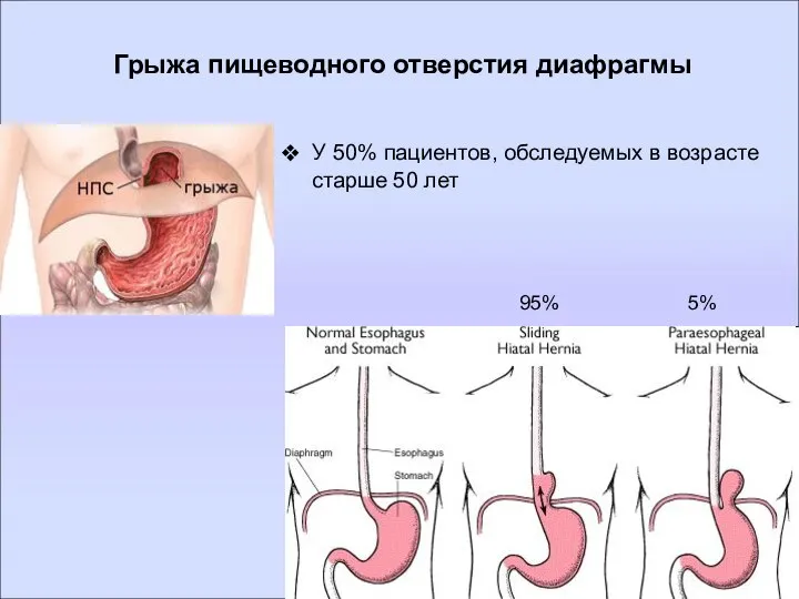 Грыжа пищеводного отверстия диафрагмы 95% 5% У 50% пациентов, обследуемых в возрасте старше 50 лет